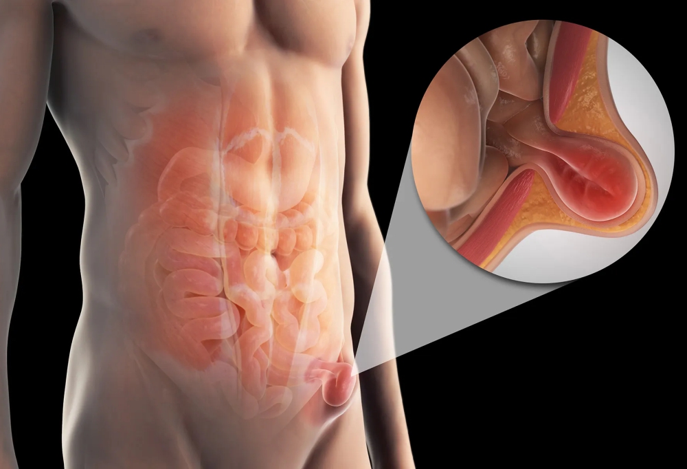 hernia