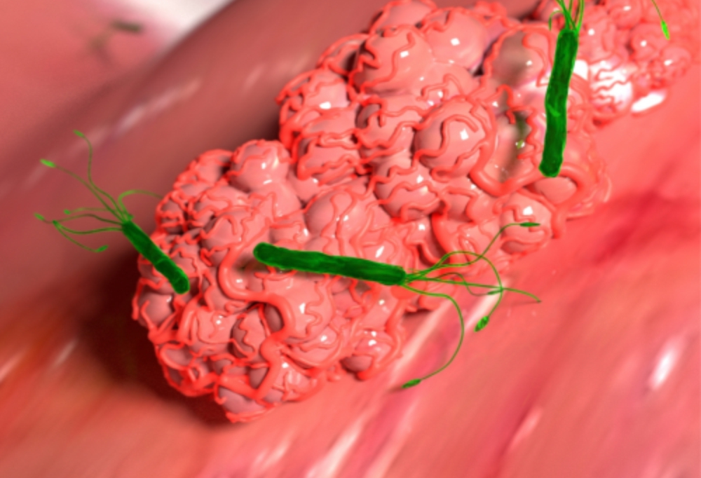 tumor