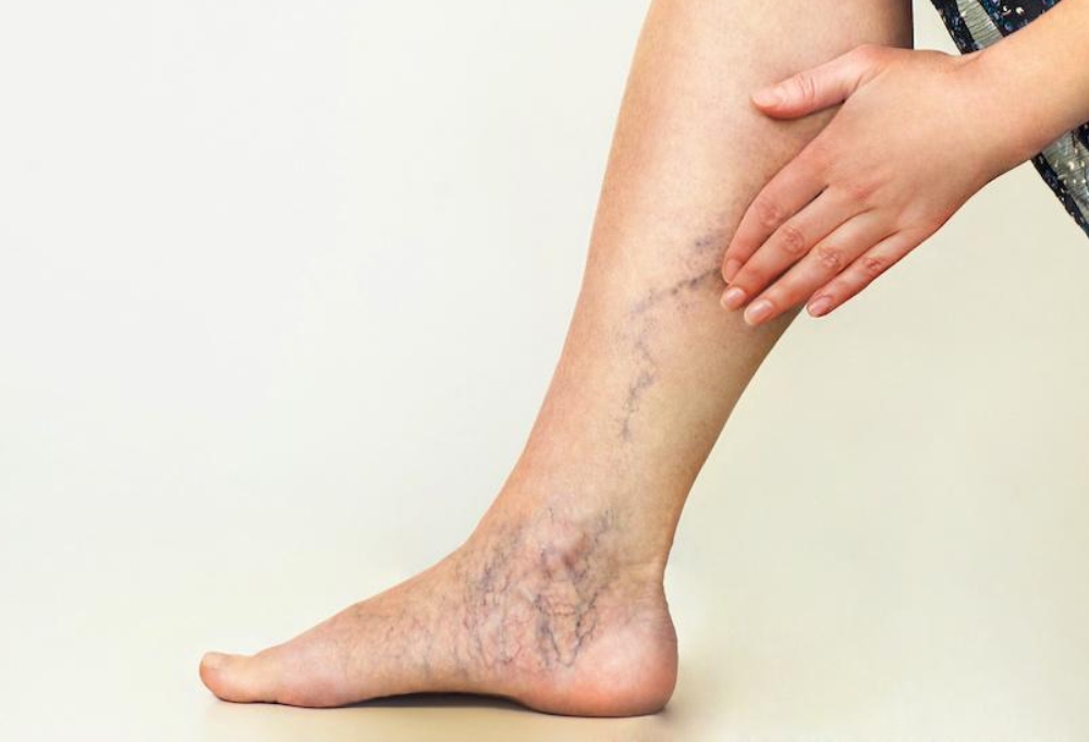 varicose veins
